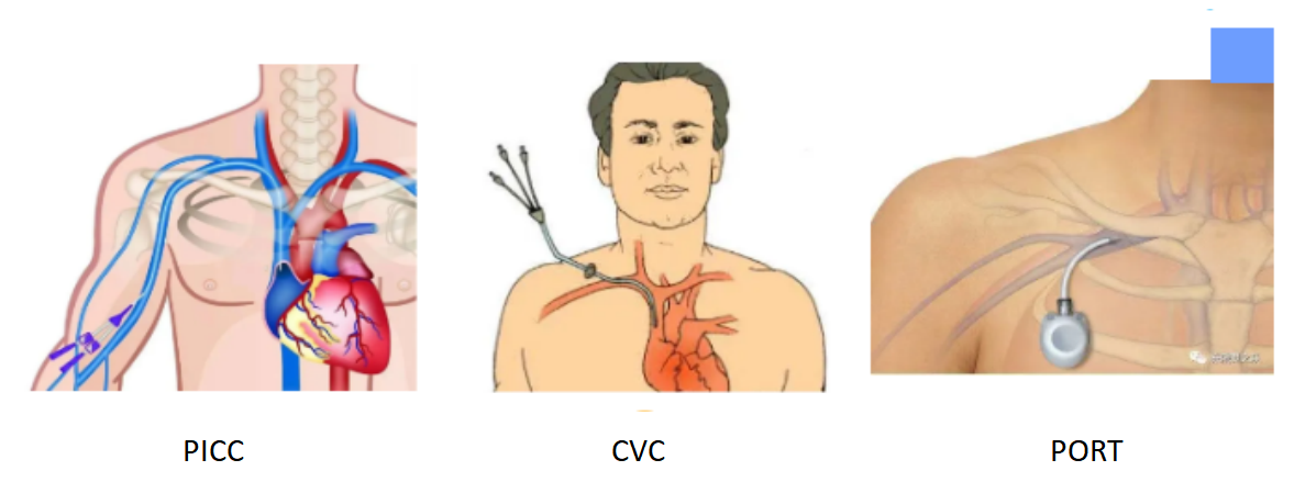 1728629111117214.png picc介绍.png